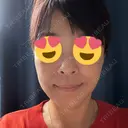 ハイフ（顔） ASTRA BEAUTY CLINIC DAY 5 サムネイル用