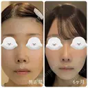 隆鼻術 / 鼻尖形成（切開） / 小鼻縮小（切開） / 軟骨移植 / 鼻柱下降・鼻唇角形成（猫手術） / ボトックス（エラ・小顔） / 毛穴洗浄（ハイドラフェイシャルなど） グローバルビューティークリニック 大阪院 AFTER サムネイル用
