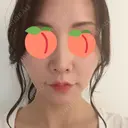 ヒアルロン酸注入（鼻） / ヒアルロン酸注入（唇） / ヒアルロン酸注入（頬） / ヒアルロン酸注入（こめかみ） BIANCA銀座 DAY 3 サムネイル用
