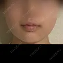ボトックス（エラ・小顔） AYANAフィラーズクリニック 武蔵小杉院 DAY 19 サムネイル用