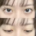 二重埋没 湘南美容クリニック 博多院 DAY 5 サムネイル用