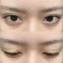 二重埋没 湘南美容クリニック 博多院 DAY 6 サムネイル用