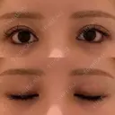 二重埋没 / 目尻切開 / 下まぶたの脂肪取り / タレ目形成・グラマラスライン（埋没） / 美容点滴・美容注射（美肌） LOUIS CLINIC 二子玉川院【ルイクリニック】 AFTER サムネイル用