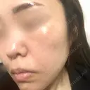 イオン導入 / ピコレーザートーニング（美白・肝斑） ルラ美容クリニック 渋谷本院 DAY 0 サムネイル用
