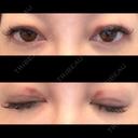 二重埋没 / 上まぶたの脂肪取り ROOTS Clinic AFTER サムネイル用