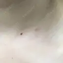 ほくろ・いぼ切除（肌） リメイ皮膚科 DAY 9 サムネイル用