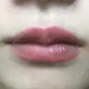 ヒアルロン酸注入（唇） リエンジャン整形外科 江南店 AFTER サムネイル用