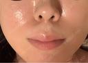 レーザーフェイシャル LIGHT CLINIC 【ライトクリニック】 新宿院 AFTER サムネイル用