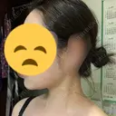 ボトックス（エラ・小顔） / 脂肪溶解注射（顔） リエンジャン整形外科 江南店 DAY 10 サムネイル用
