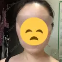 ボトックス（エラ・小顔） / 脂肪溶解注射（顔） リエンジャン整形外科 江南店 AFTER サムネイル用