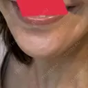 ボトックス（あご） TCB東京中央美容外科 藤沢院 DAY 21 サムネイル用