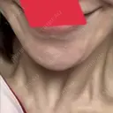ボトックス（あご） TCB東京中央美容外科 藤沢院 DAY 28 サムネイル用