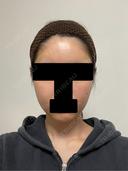 糸リフト / バッカルファット除去 / 脂肪吸引（顔） / 脂肪注入（額） / ボトックス（あご） / 脂肪注入（輪郭） セギム美容整形外科 AFTER サムネイル用