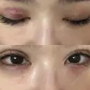自然癒着法 シンデレラ＆ダヴィンチクリニック DAY 1 サムネイル用