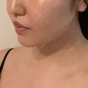 脂肪吸引（顔） / 脂肪吸引（二の腕） 湘南美容クリニック 京都院 DAY 30 サムネイル用
