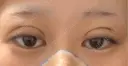 二重埋没 / 鼻尖形成（切開） / 鼻尖縮小 / 小鼻縮小（非切開） R Beauty CLINIC 大阪院 DAY 1 サムネイル用