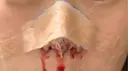 二重埋没 / 鼻尖形成（切開） / 鼻尖縮小 / 小鼻縮小（非切開） R Beauty CLINIC 大阪院 DAY 1 サムネイル用