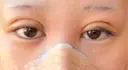 二重埋没 / 鼻尖形成（切開） / 鼻尖縮小 / 小鼻縮小（非切開） R Beauty CLINIC 大阪院 DAY 2 サムネイル用