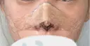 二重埋没 / 鼻尖形成（切開） / 鼻尖縮小 / 小鼻縮小（非切開） R Beauty CLINIC 大阪院 AFTER サムネイル用