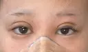 二重埋没 / 鼻尖形成（切開） / 鼻尖縮小 / 小鼻縮小（非切開） R Beauty CLINIC 大阪院 DAY 3 サムネイル用