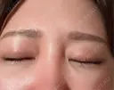 ヒアルロン酸注入（目の下） / ボトックス（眉間） CLINIC W DAY 10 サムネイル用