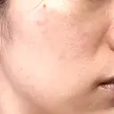 白玉点滴・注射 / シミ取りレーザー S-Laboクリニック 渋谷院 AFTER サムネイル用