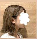 糸リフト / 脂肪吸引（顔） セギム美容整形外科 AFTER サムネイル用