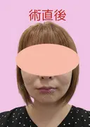 糸リフト / 脂肪吸引（顔） / メーラーファット除去 / ジョールファット除去 / 脂肪吸引注射（顔） ziz CLINIC DAY 0 サムネイル用