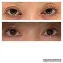 眼瞼下垂（非切開） SOL CLINIC AFTER サムネイル用
