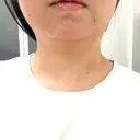 脂肪溶解注射（顔） / ハイフ（顔） AZ BEAUTY CLINIC DAY 1 サムネイル用