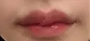 ヒアルロン酸注入（唇） / ボトックス（口角） KAGA CLINIC DAY 2 サムネイル用