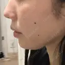 ボトックス（あご） / ヒアルロン酸注入（あご） BIZENNクリニック【ビゼンクリニック】 AFTER サムネイル用