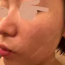 水光注射（ハリ・美肌） スマートスキンクリニック 神保町院 AFTER サムネイル用