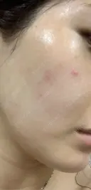美容点滴・美容注射（ダイエット） / 美容点滴・美容注射（疲労回復） / ピコレーザートーニング（美白・肝斑） / ピーリング（ハリ・ツヤ） / ピコフラクショナルレーザー（毛穴・ニキビ跡） 表参道メディカルクリニック 大阪院 DAY 1 サムネイル用