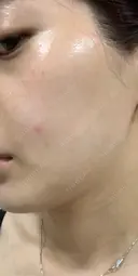 美容点滴・美容注射（ダイエット） / 美容点滴・美容注射（疲労回復） / ピコレーザートーニング（美白・肝斑） / ピーリング（ハリ・ツヤ） / ピコフラクショナルレーザー（毛穴・ニキビ跡） 表参道メディカルクリニック 大阪院 DAY 1 サムネイル用