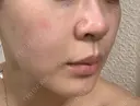 美容点滴・美容注射（ダイエット） / 美容点滴・美容注射（疲労回復） / ピコレーザートーニング（美白・肝斑） / ピーリング（ハリ・ツヤ） / ピコフラクショナルレーザー（毛穴・ニキビ跡） 表参道メディカルクリニック 大阪院 DAY 2 サムネイル用