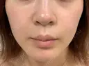 美容点滴・美容注射（ダイエット） / 美容点滴・美容注射（疲労回復） / ピコレーザートーニング（美白・肝斑） / ピーリング（ハリ・ツヤ） / ピコフラクショナルレーザー（毛穴・ニキビ跡） 表参道メディカルクリニック 大阪院 AFTER サムネイル用