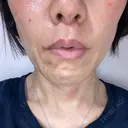 人中短縮 / 口角挙上 / その他（口元） ルラ美容クリニック 神戸院 DAY 33 サムネイル用