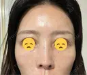 水光注射（ハリ・美肌） オラクル美容皮膚科 東京新宿院 DAY 2 サムネイル用