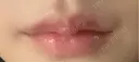 ヒアルロン酸注入（唇） / ボトックス（口角） KAGA CLINIC DAY 5 サムネイル用
