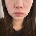 ボトックス（エラ・小顔） TCB東京中央美容外科 福岡博多院 AFTER サムネイル用