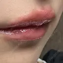 ヒアルロン酸注入（涙袋） / ヒアルロン酸注入（唇） 東京シンデレラ美容外科 大宮院 DAY 1 サムネイル用