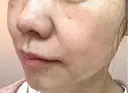 光治療（フォトフェイシャルなど） 大美会クリニック 岡山院 DAY 27 サムネイル用