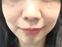 光治療（フォトフェイシャルなど） 大美会クリニック 岡山院 DAY 33 サムネイル用