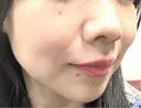 光治療（フォトフェイシャルなど） 大美会クリニック 岡山院 DAY 33 サムネイル用