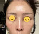 水光注射（ハリ・美肌） オラクル美容皮膚科 東京新宿院 DAY 6 サムネイル用