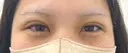二重埋没 / ヒアルロン酸注入（涙袋） BELINDA CLINIC（ベリンダクリニック）新宿院 DAY 0 サムネイル用