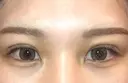 二重埋没 / ヒアルロン酸注入（涙袋） BELINDA CLINIC（ベリンダクリニック）新宿院 DAY 14 サムネイル用