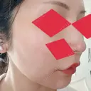 ヒアルロン酸注入（鼻） / ヒアルロン酸注入（唇） / ヒアルロン酸注入（頬） / ヒアルロン酸注入（こめかみ） BIANCA銀座 AFTER サムネイル用