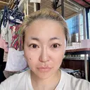 その他（鼻） / ボトックス（エラ・小顔） ルラ美容クリニック 新潟院 AFTER サムネイル用